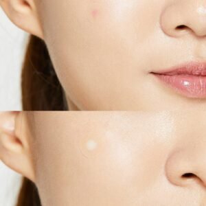 COSRX Acne Pimple - Figura 4
